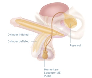 Inflatable penile implant