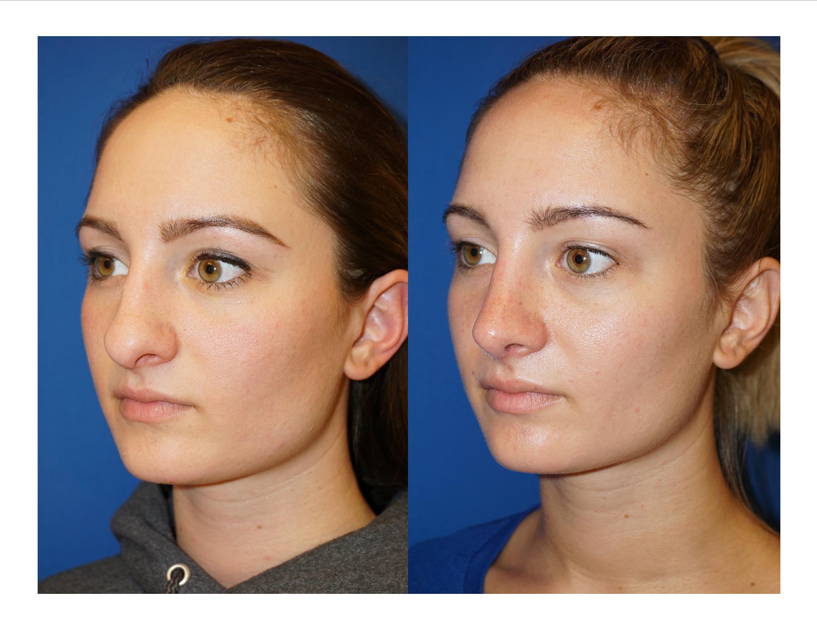 Rhinoplasty 1 Image 4