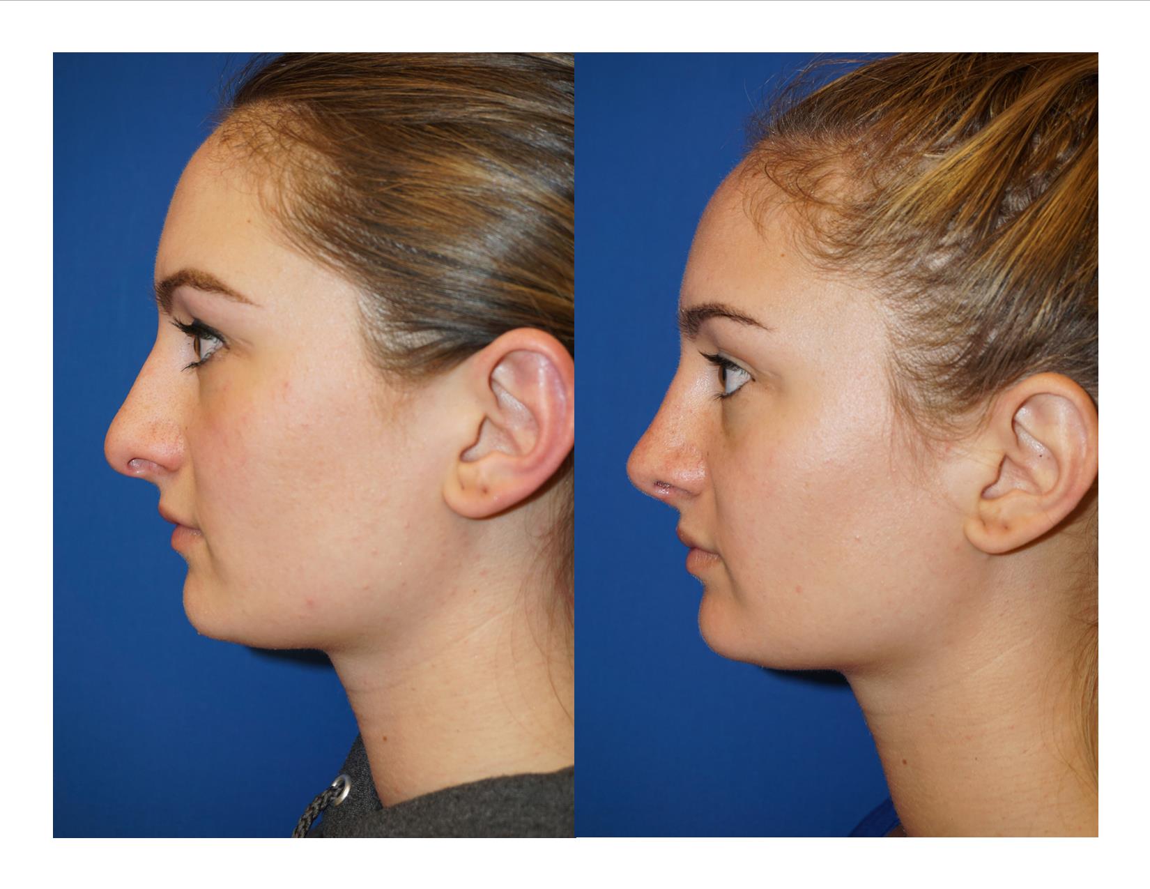 Rhinoplasty 1 Image 5