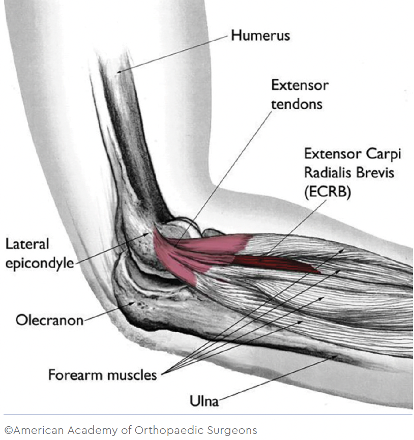 tennis elbow illustration