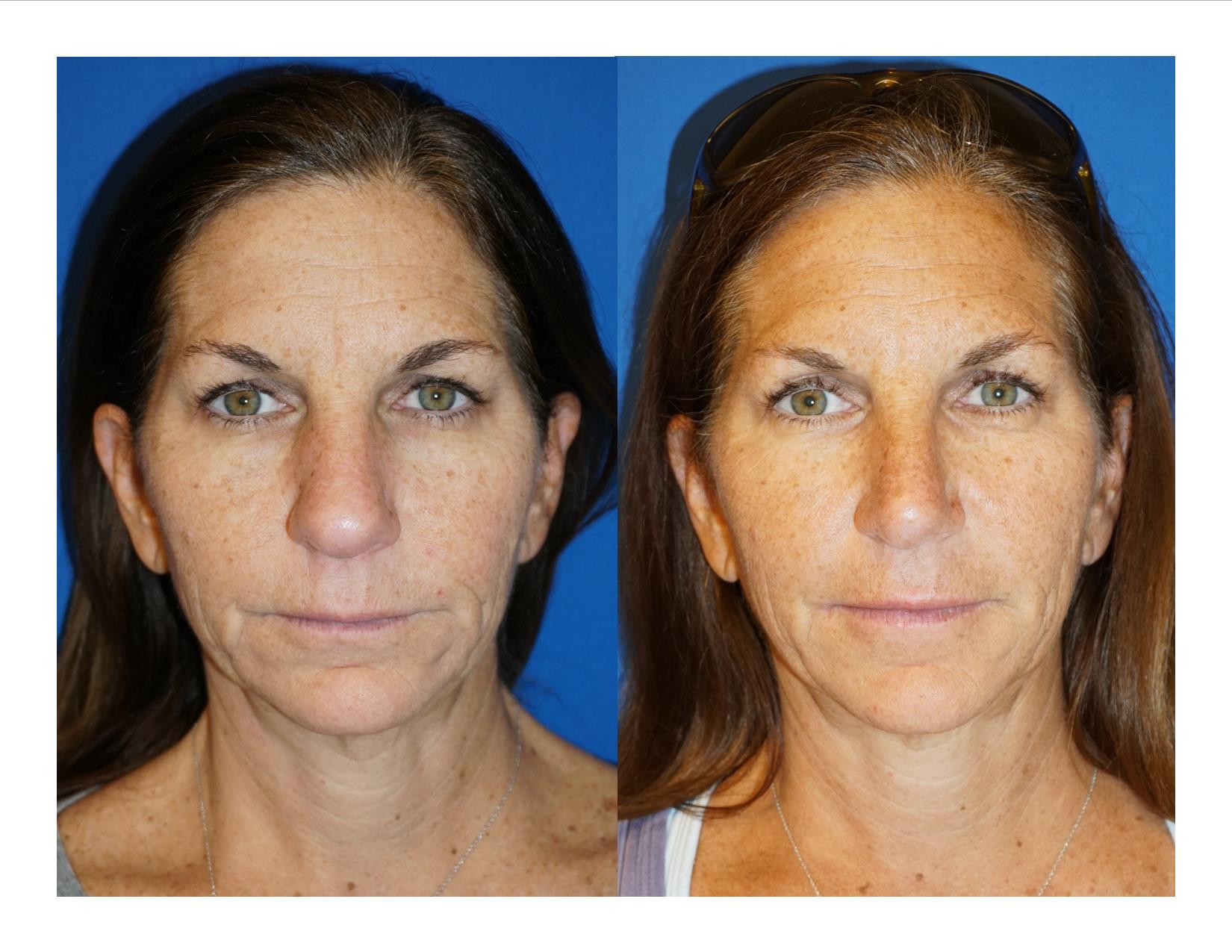 Rhinoplasty 7 Image 1 