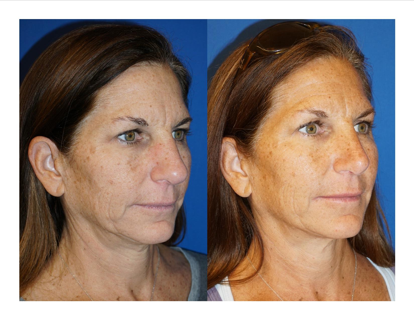 Rhinoplasty 7 Image 2 