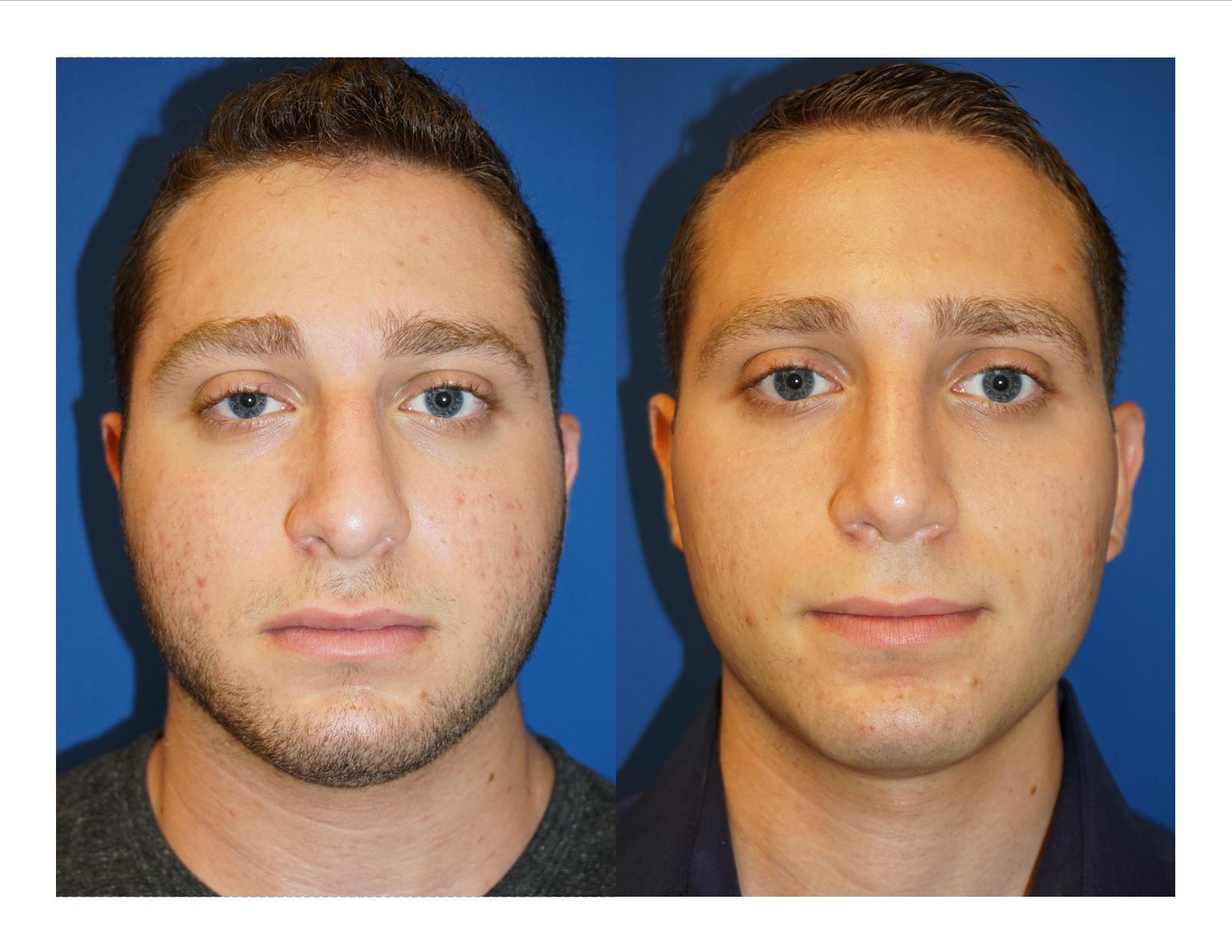 Rhinoplasty 2 Image 1 