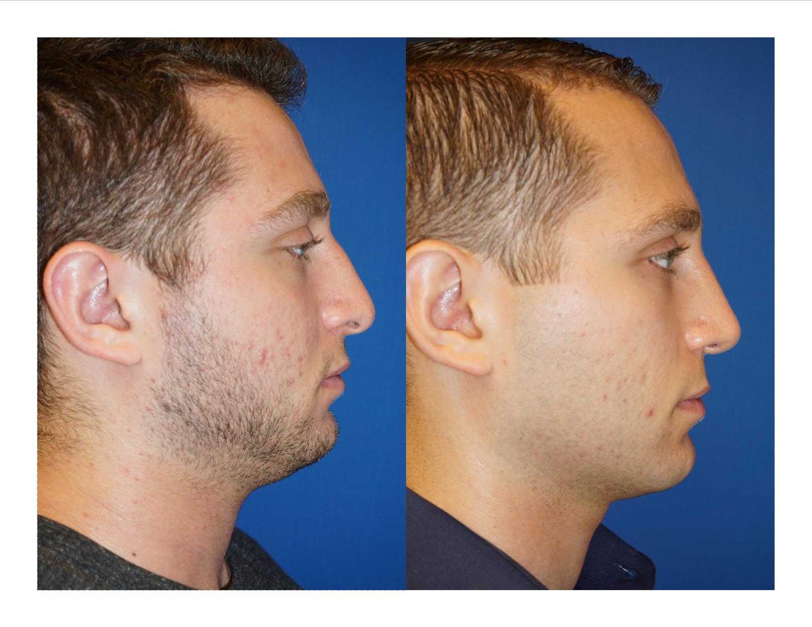 Rhinoplasty 2 Image 3