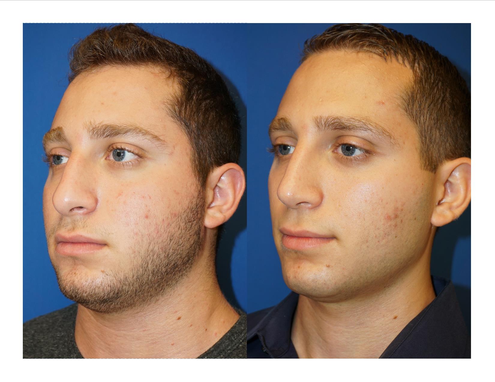 Rhinoplasty 2 Image 4