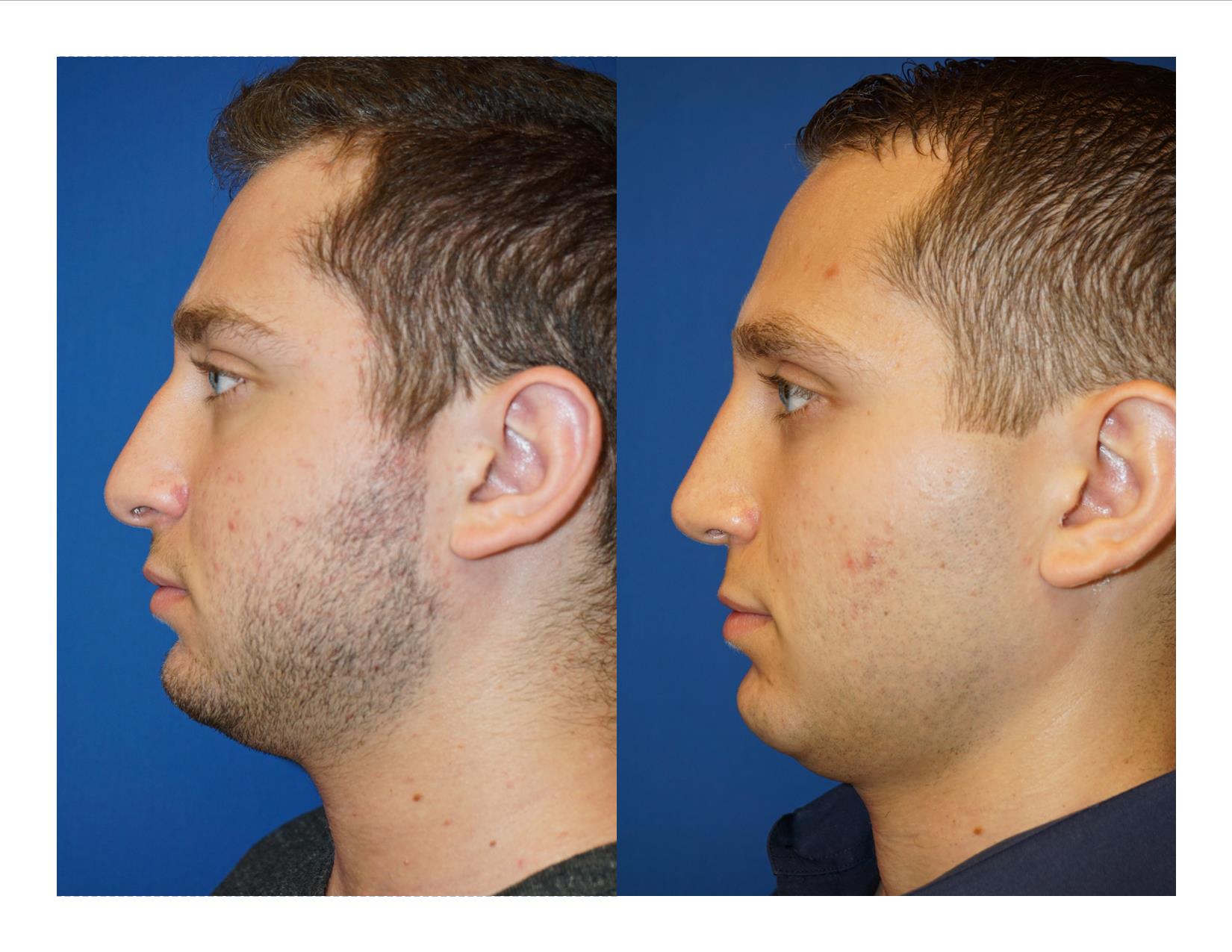 Rhinoplasty 2 Image 5