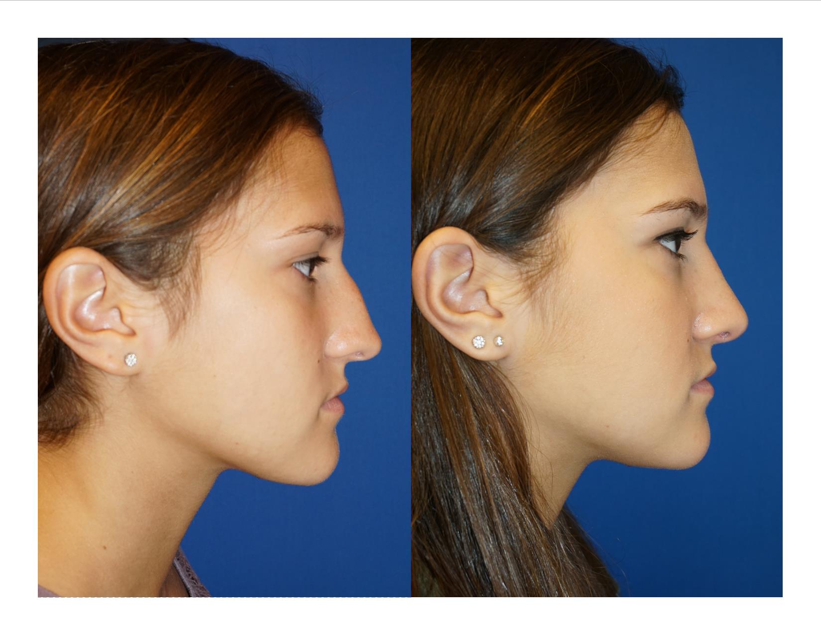 Rhinoplasty 9 Image 1