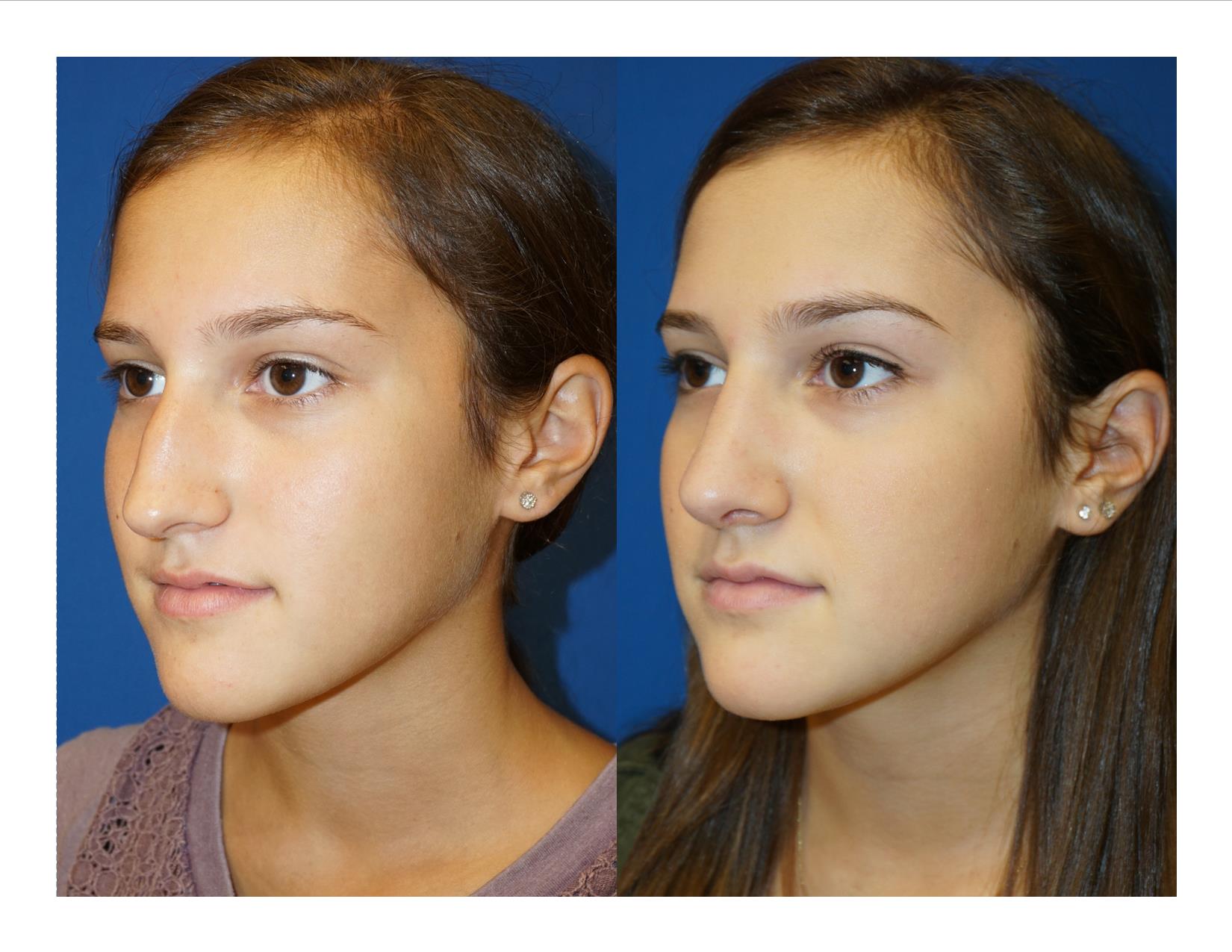 Rhinoplasty 9 Image 4