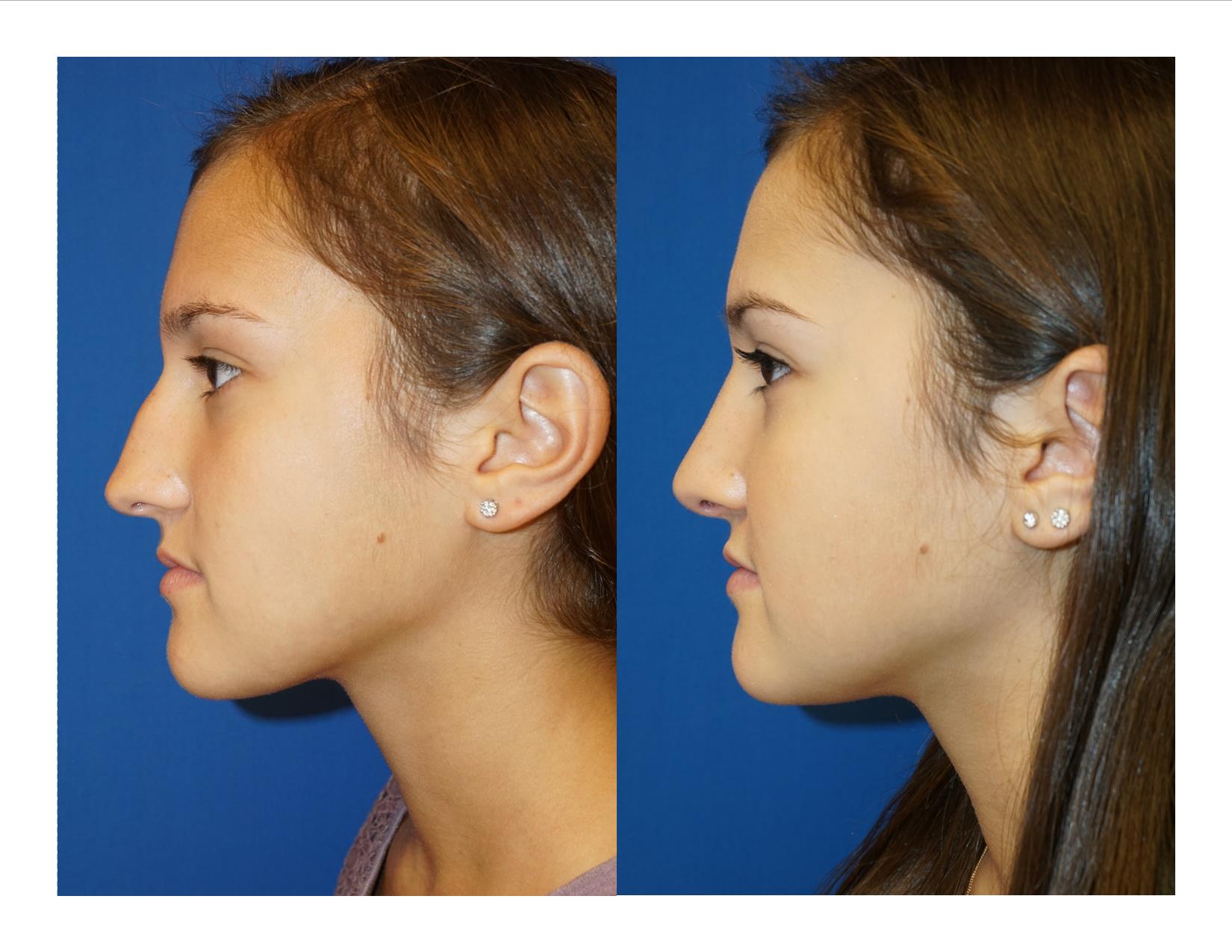 Rhinoplasty 9 Image 5