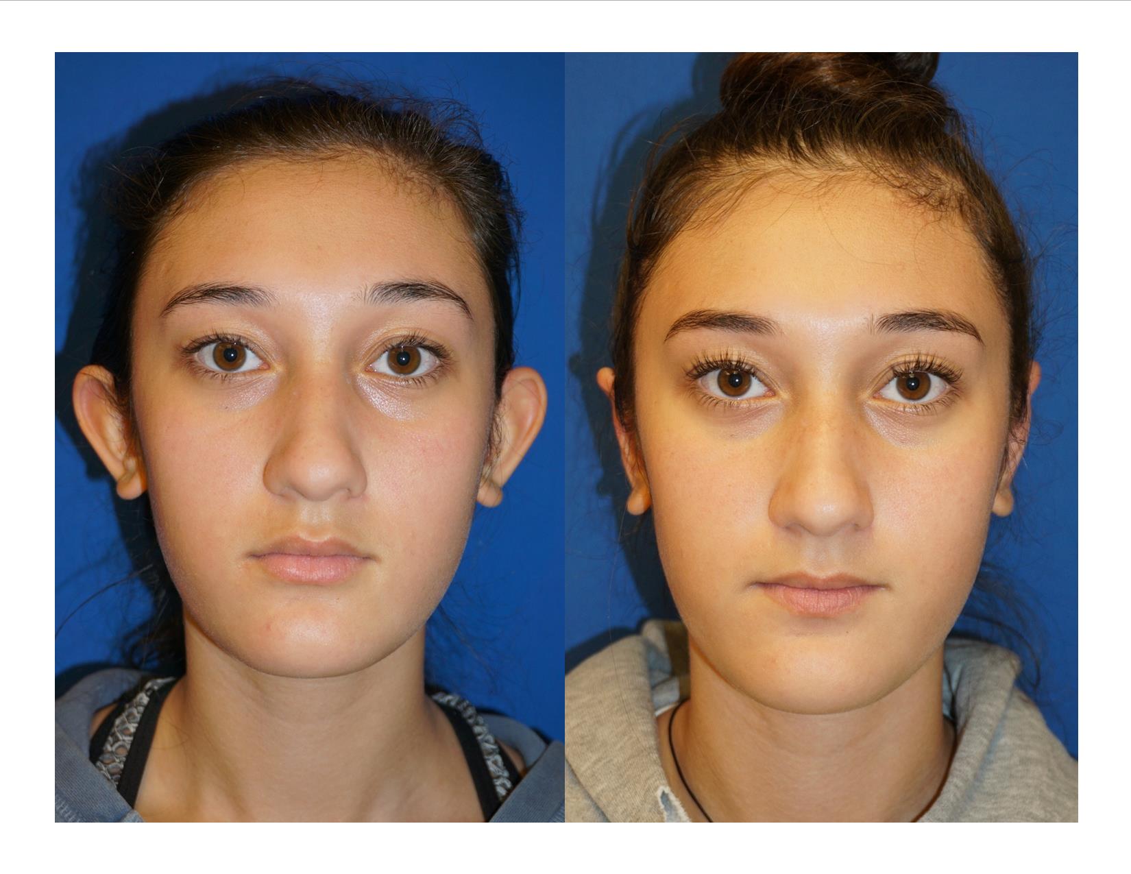 Otoplasty 2 Image 1