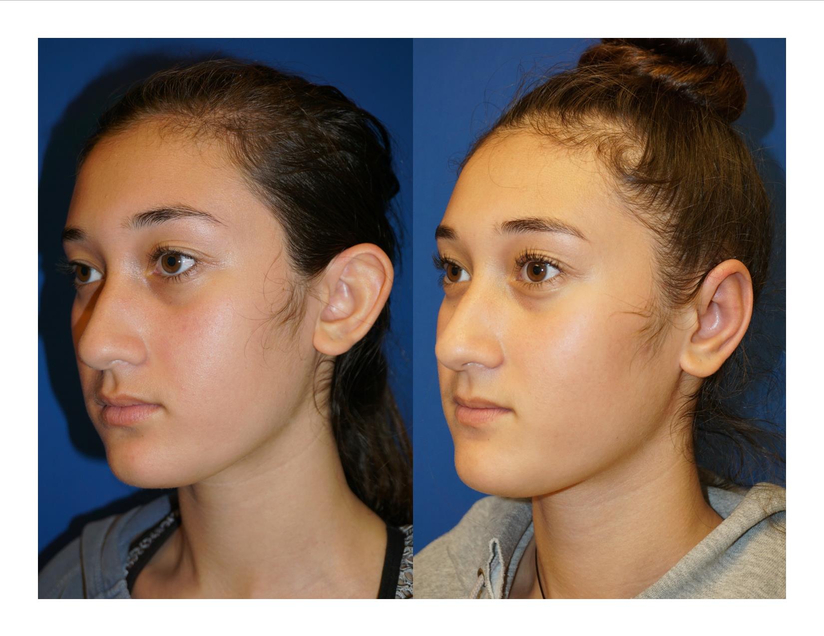 Otoplasty 2 Image 2