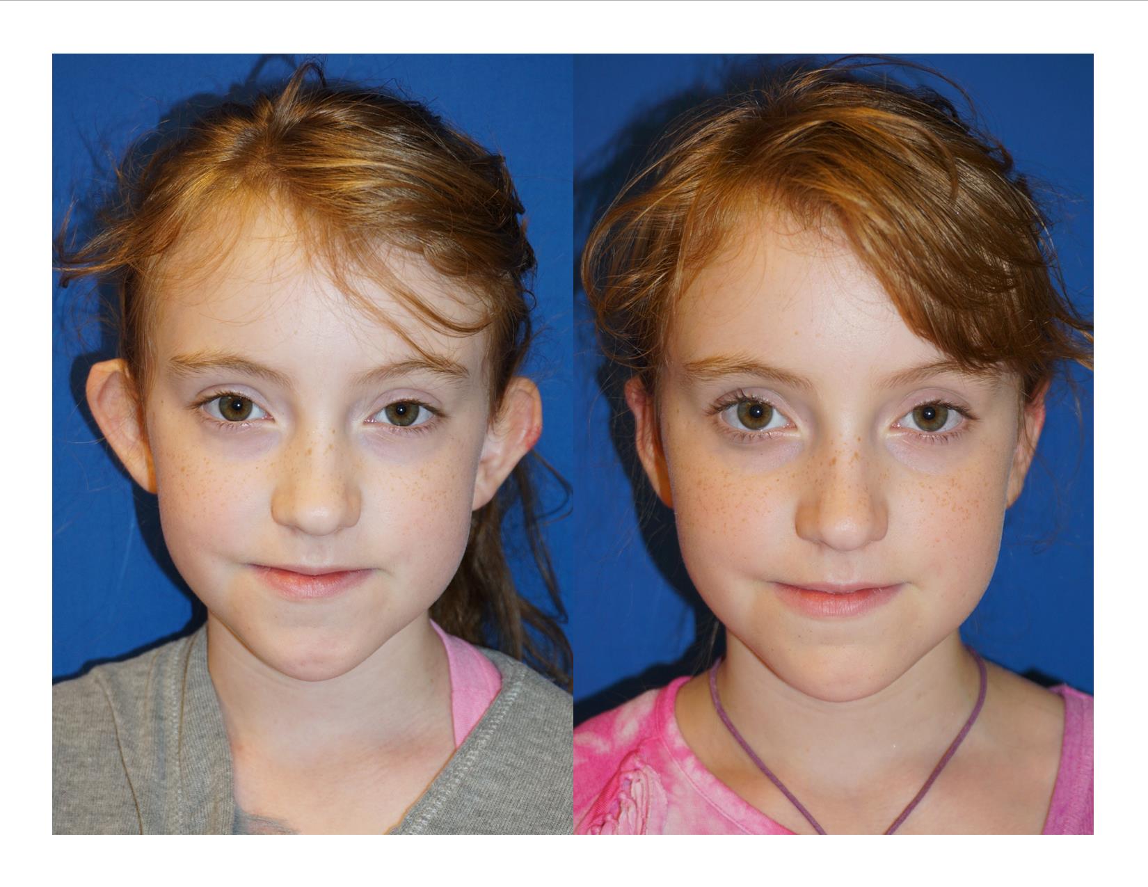 Facial Plastic and Reconstructive Surgery Before & After Summit Health