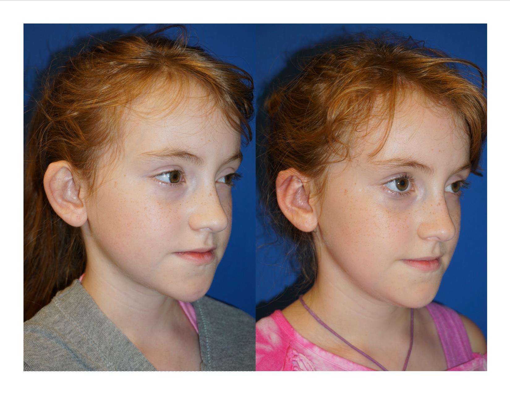 Image 4 Otoplasty 1