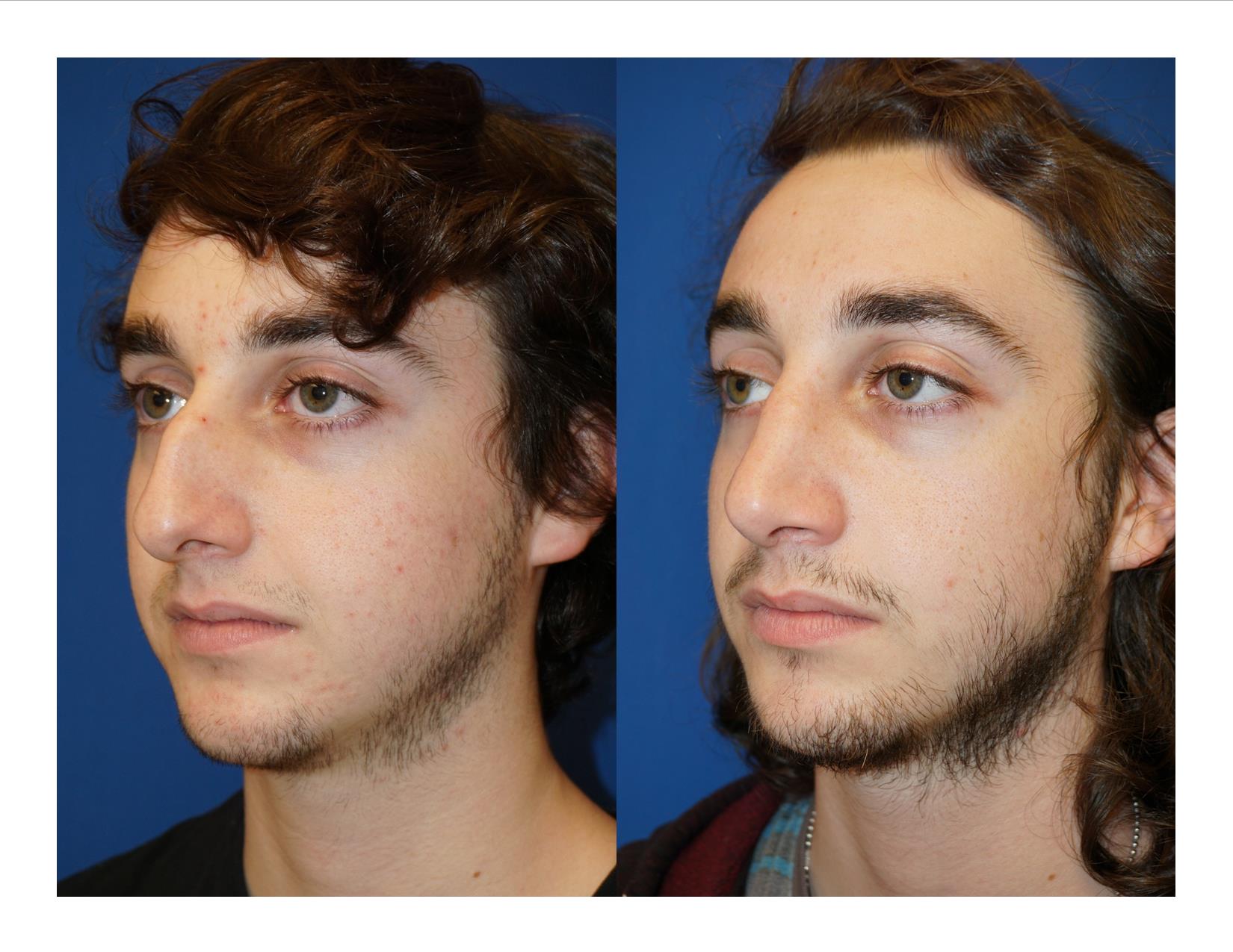 Rhinoplasty 8 Image 2