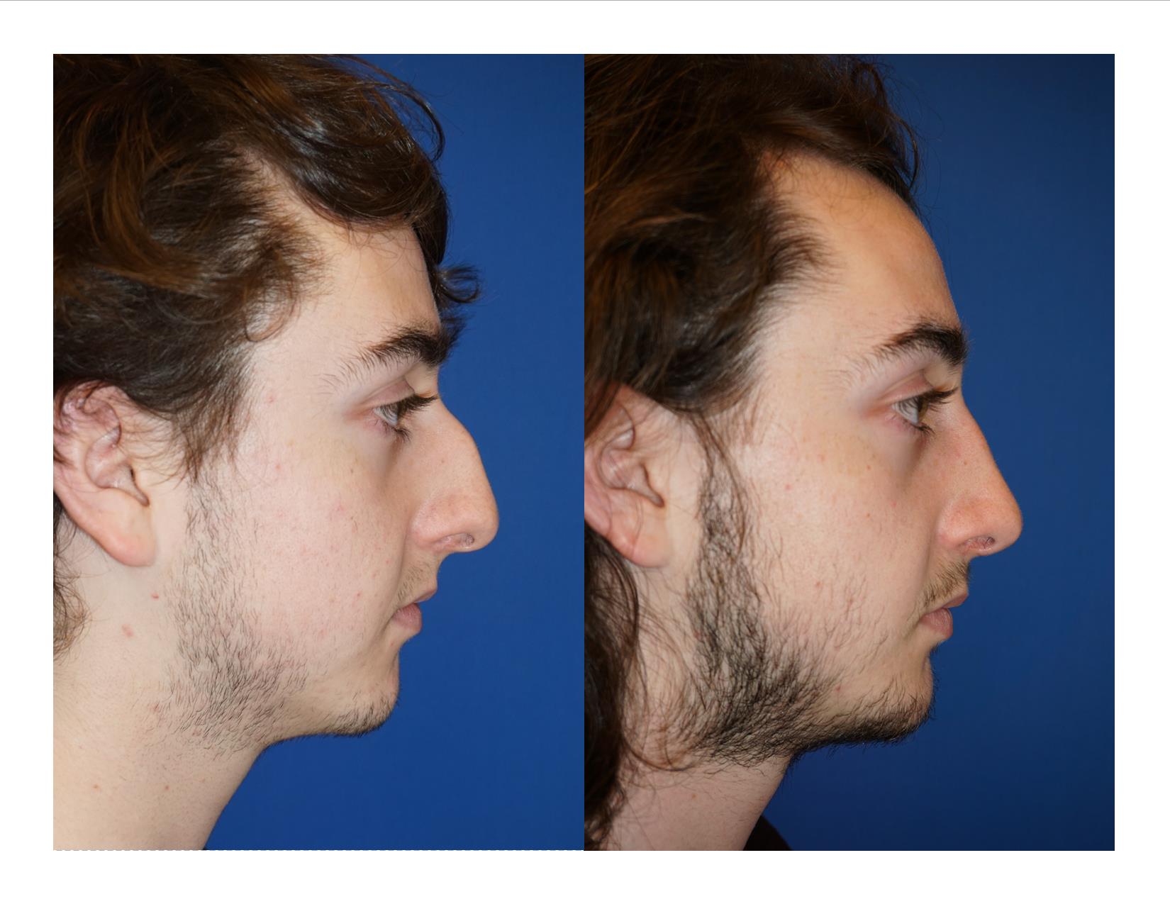 Rhinoplasty 8 Image 5