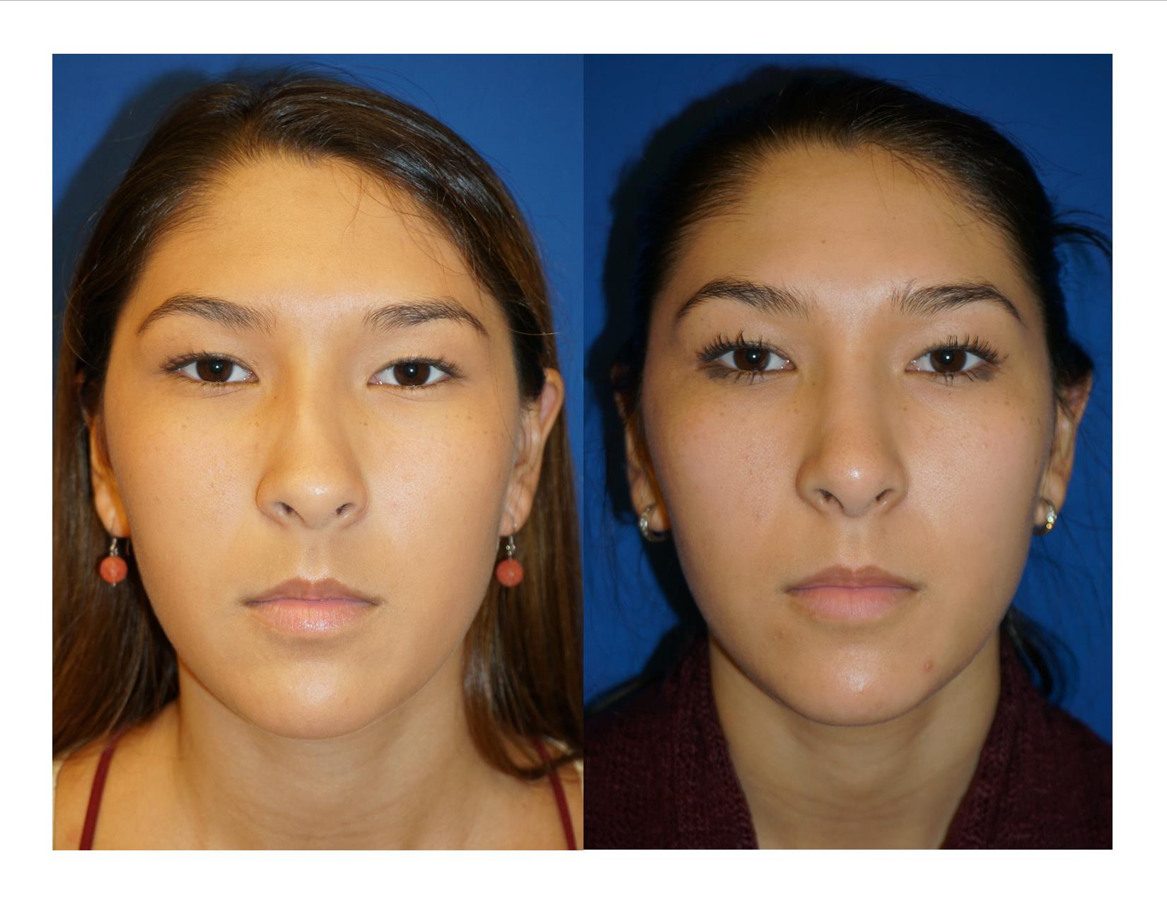 Rhinoplasty 11 Image 1