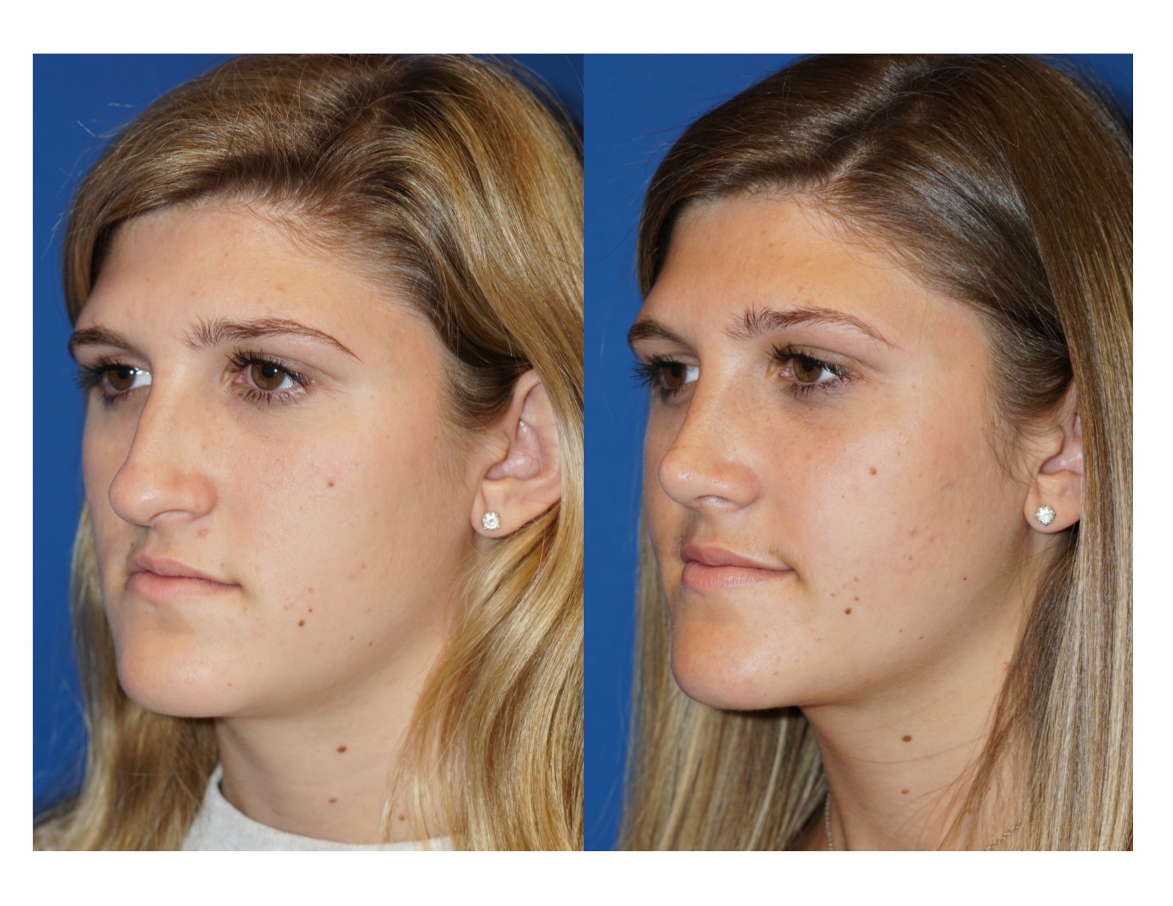 Rhinoplasty 4 Image 2 
