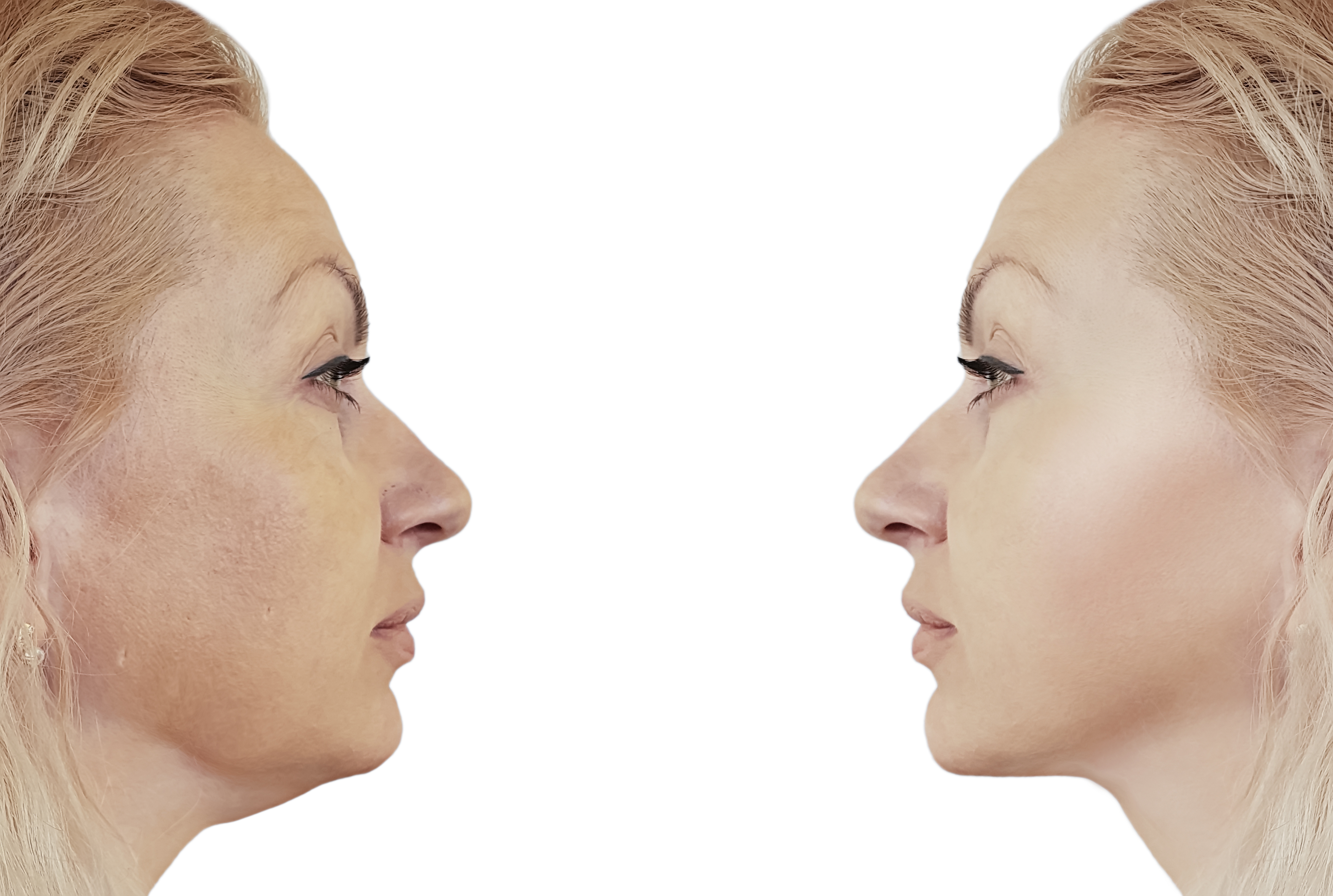 woman double chin before and after procedures, retouching