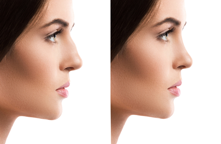 Comparison of female face after rhinoplasty on white background