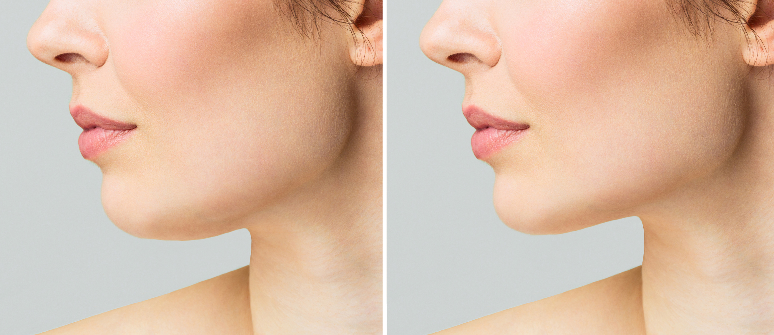 A close portrait of an aged woman before and after Kybella treatment for double chin