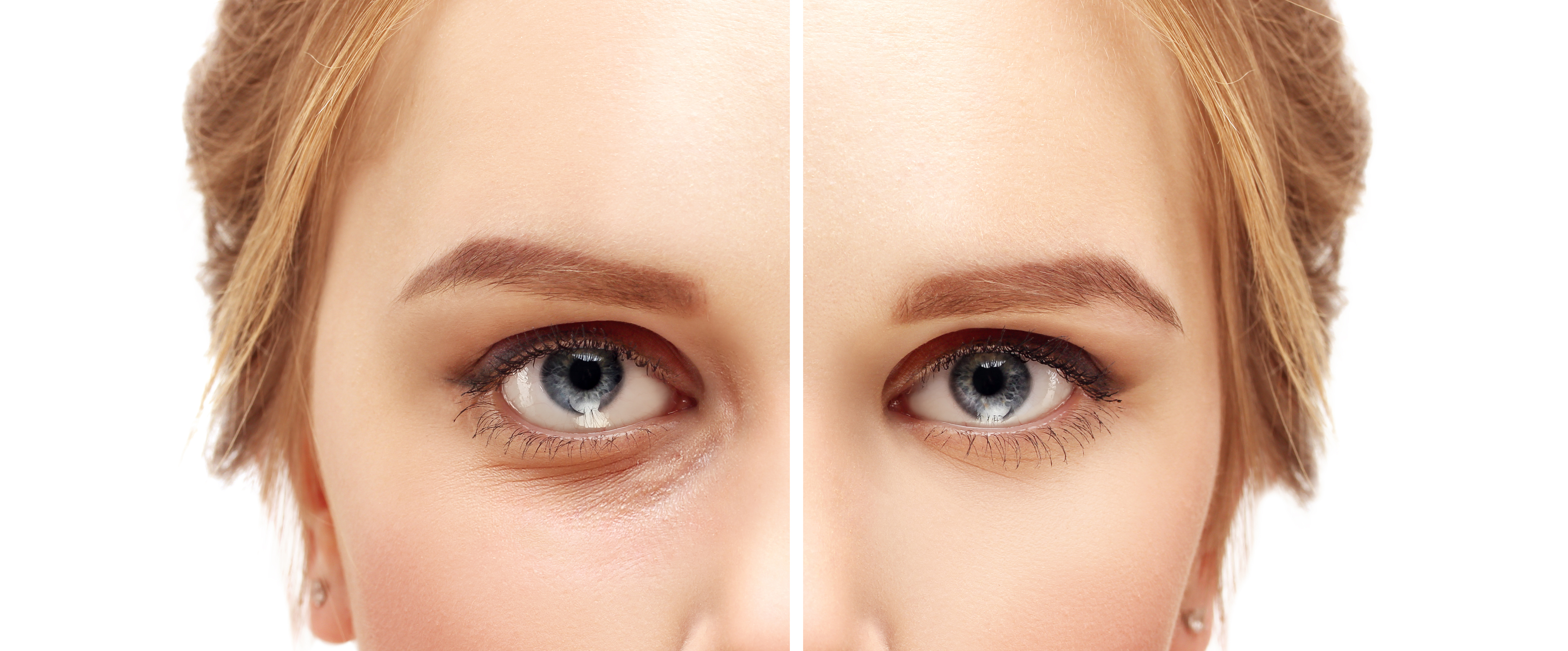 Lower-Eyelid Blepharoplasty
