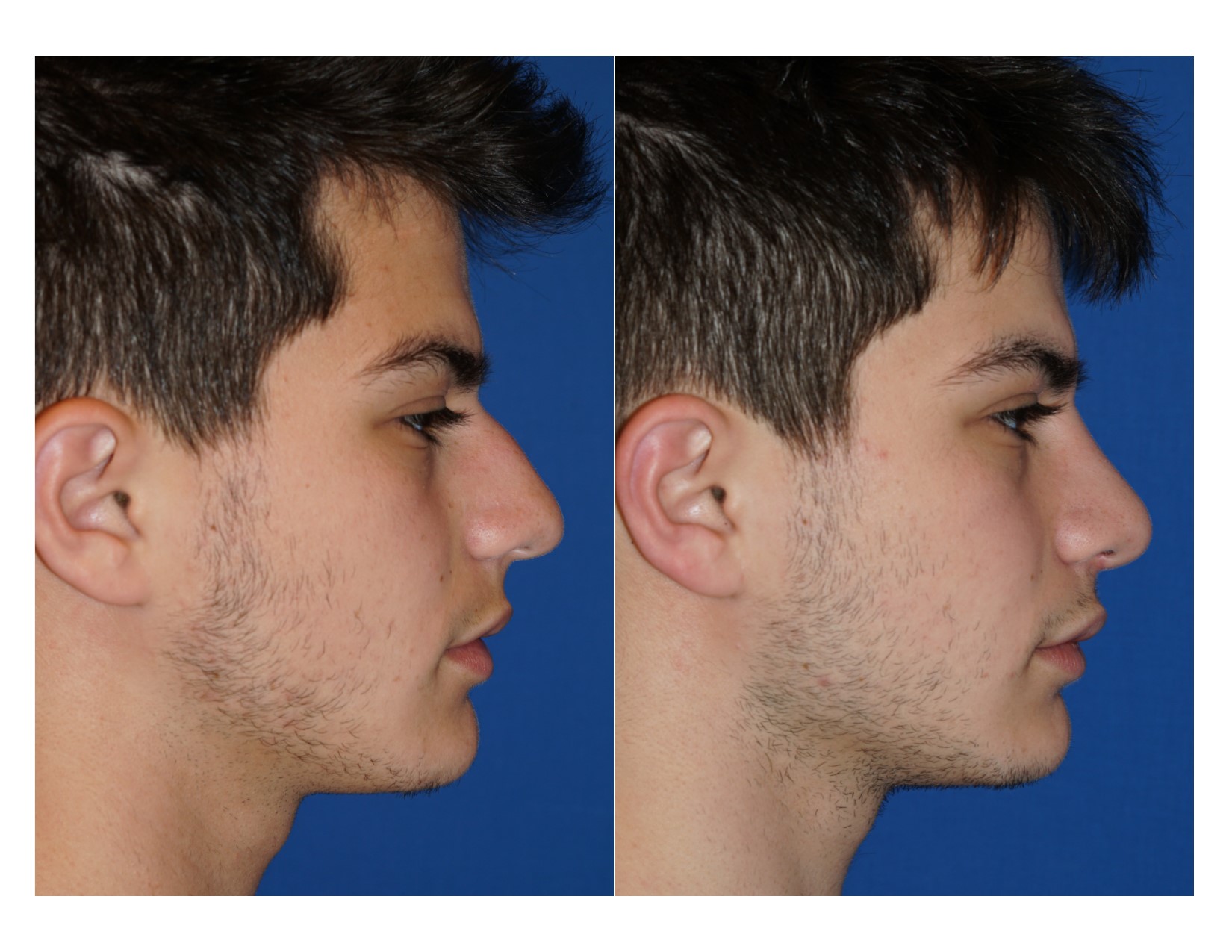 Rhinoplasty 10 Image 1