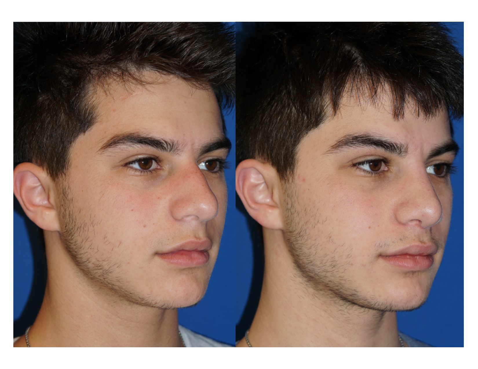 Rhinoplasty 10 Image 2