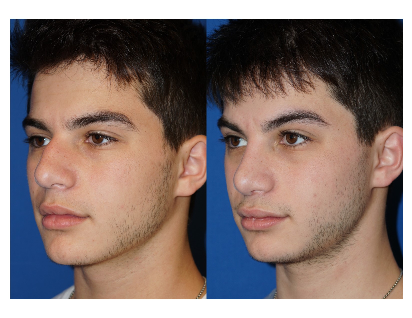 Rhinoplasty 10 Image 4