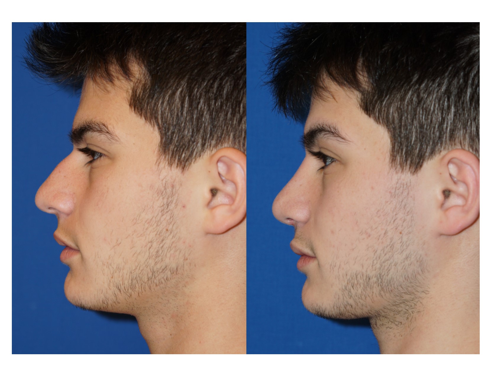Rhinoplasty 10 Image 5