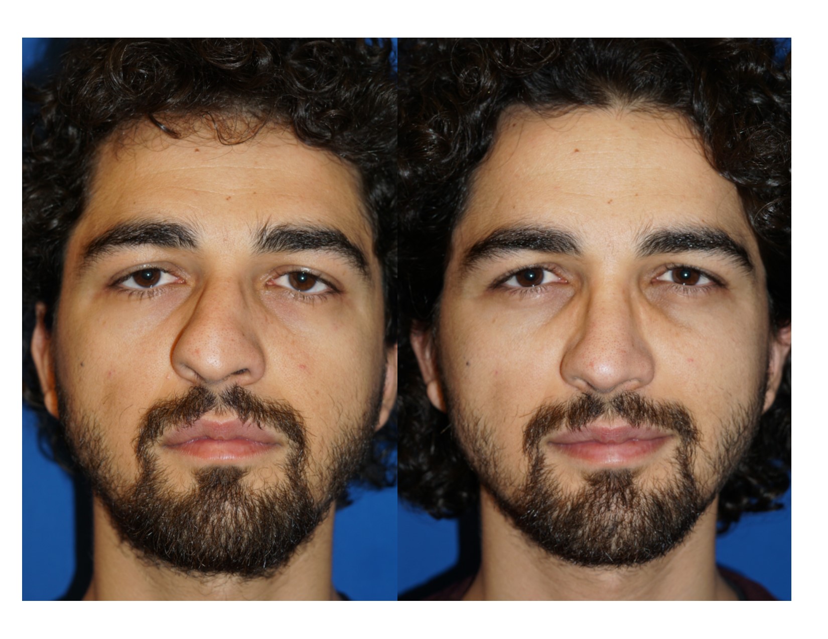 Rhinoplasty 13 Image 1