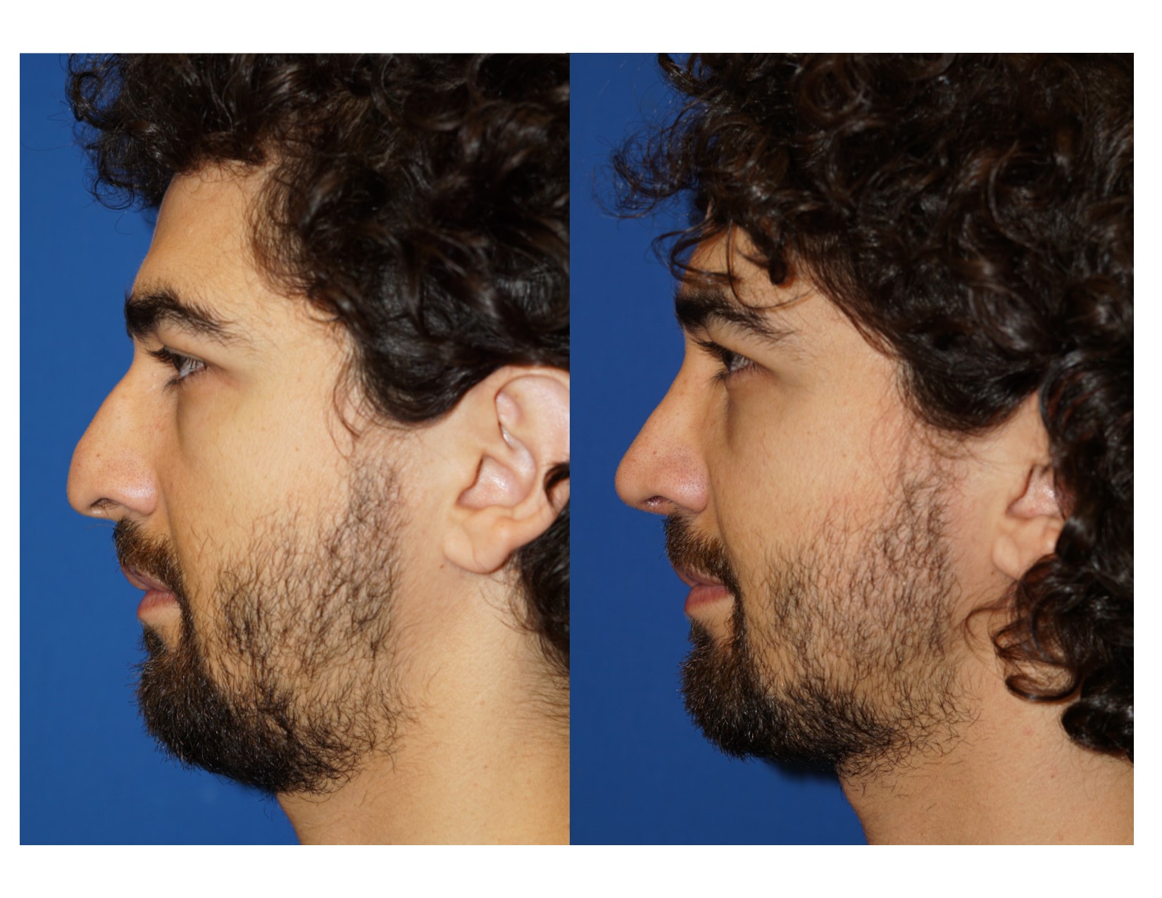 Rhinoplasty 13 Image 3 