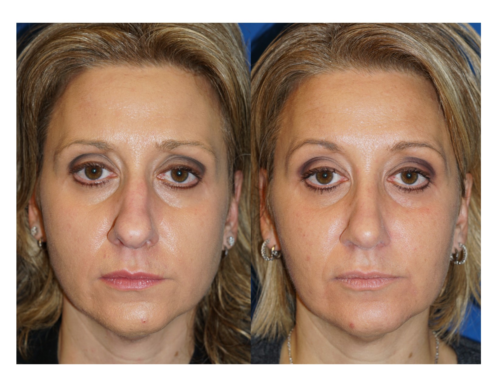 Rhinoplasty 14 Image 1