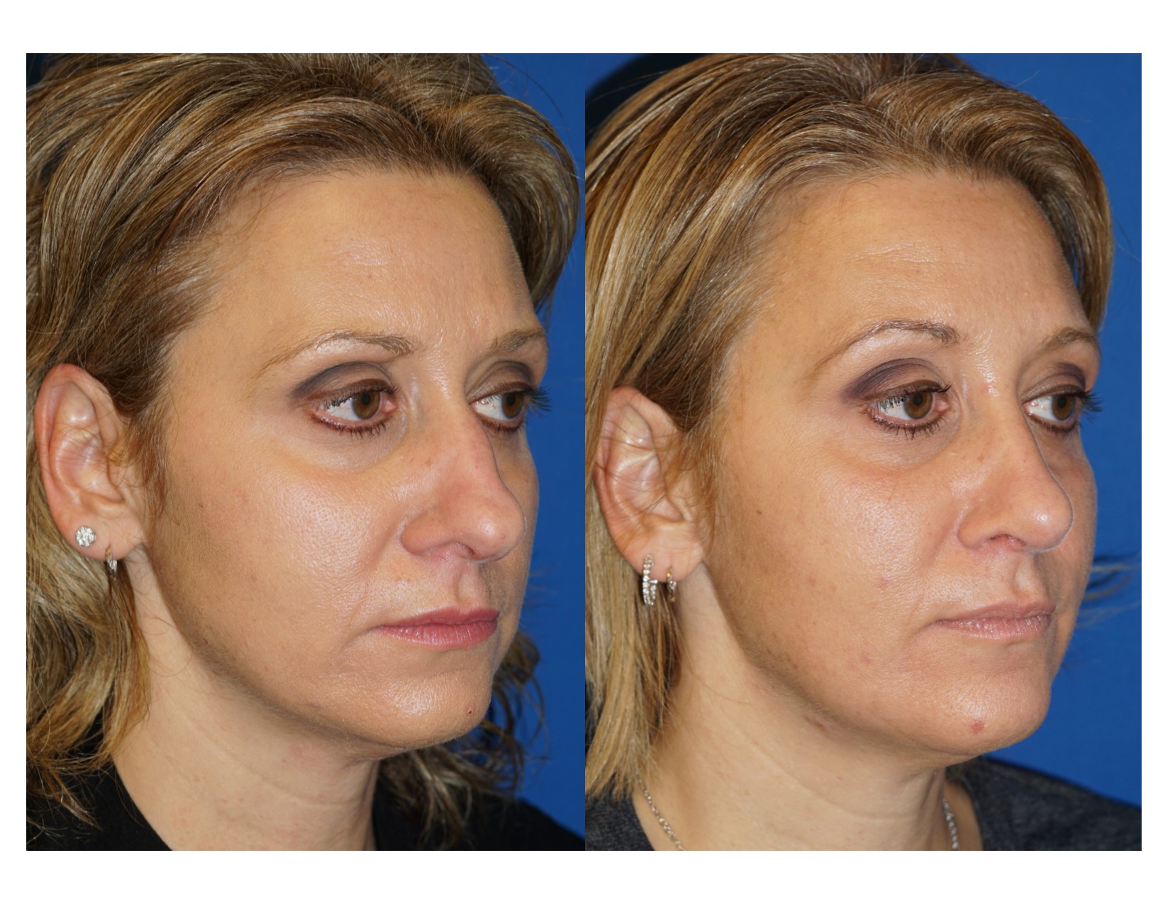 Rhinoplasty 14 Image 2