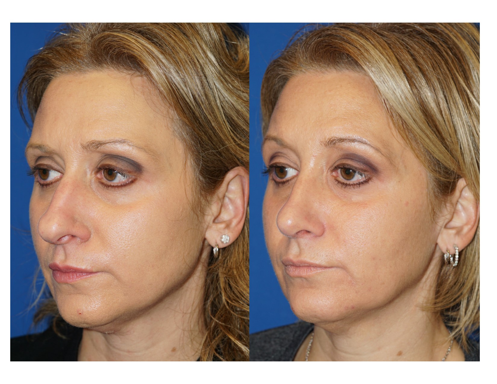 Rhinoplasty 14 Image 4