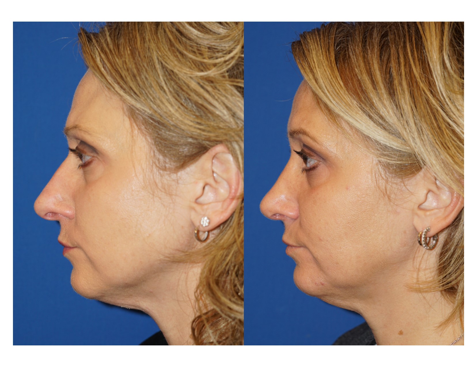 Rhinoplasty 14 Image 5