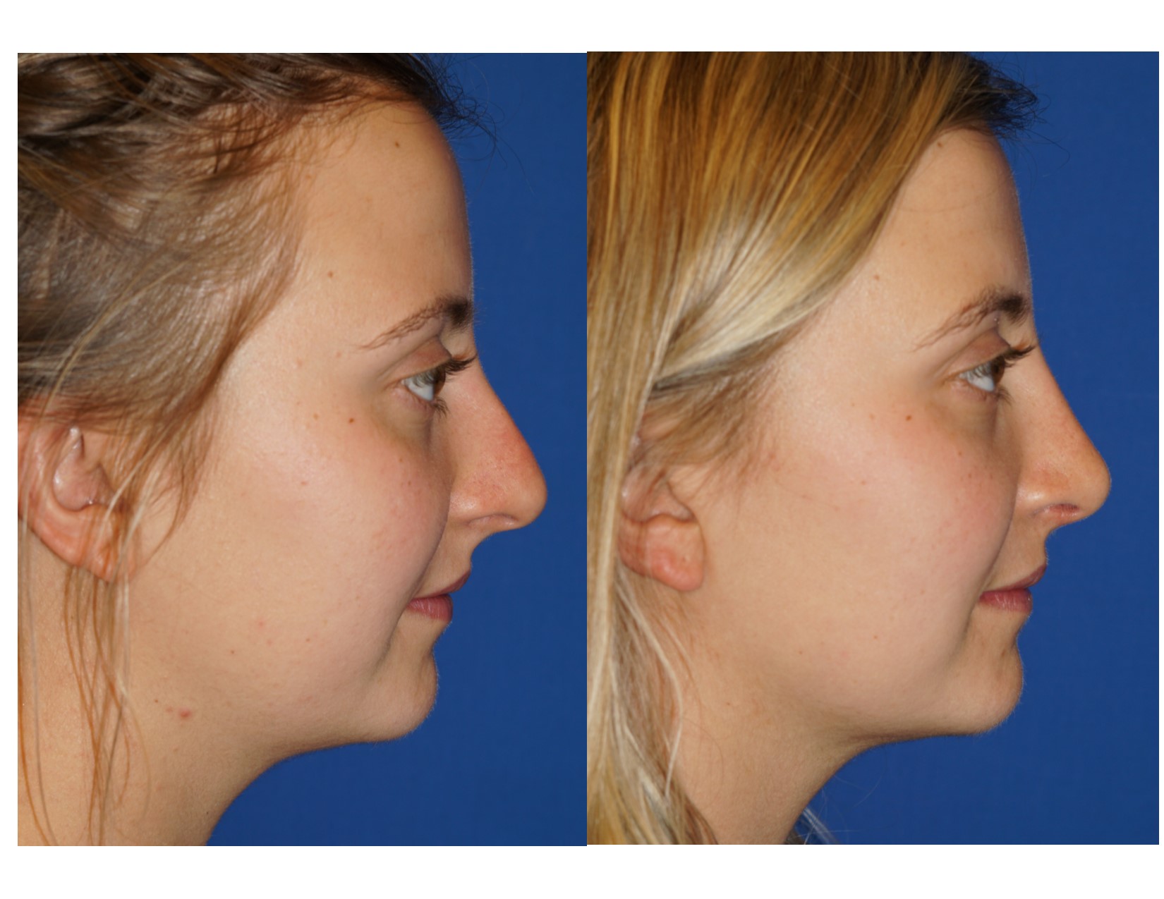 Rhinoplasty 15 Image 1