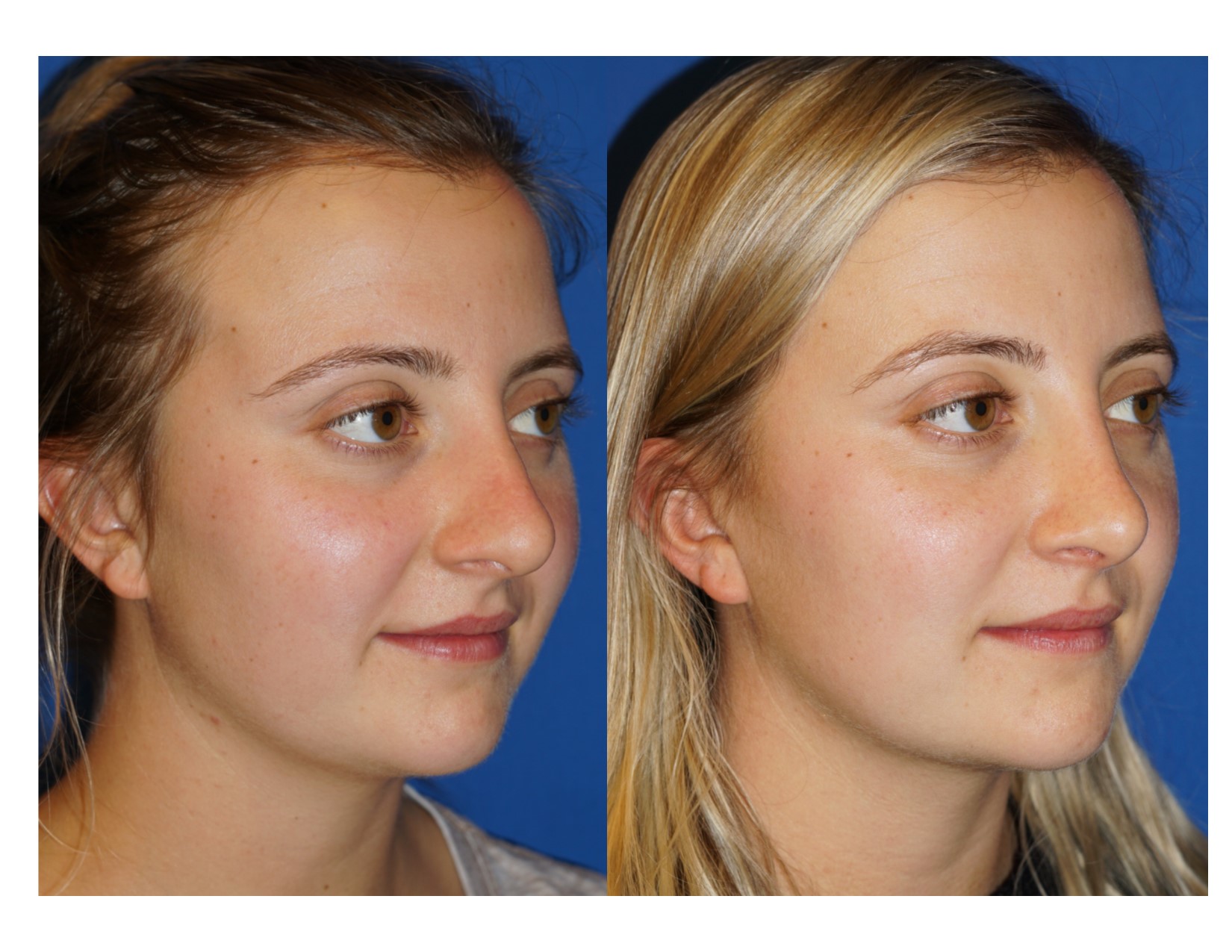 Rhinoplasty 15 Image 2