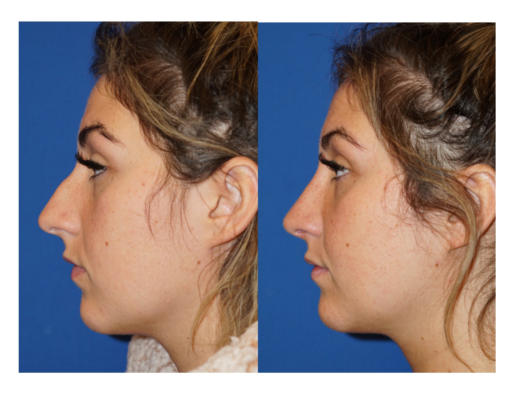 rhinoplasty3_3