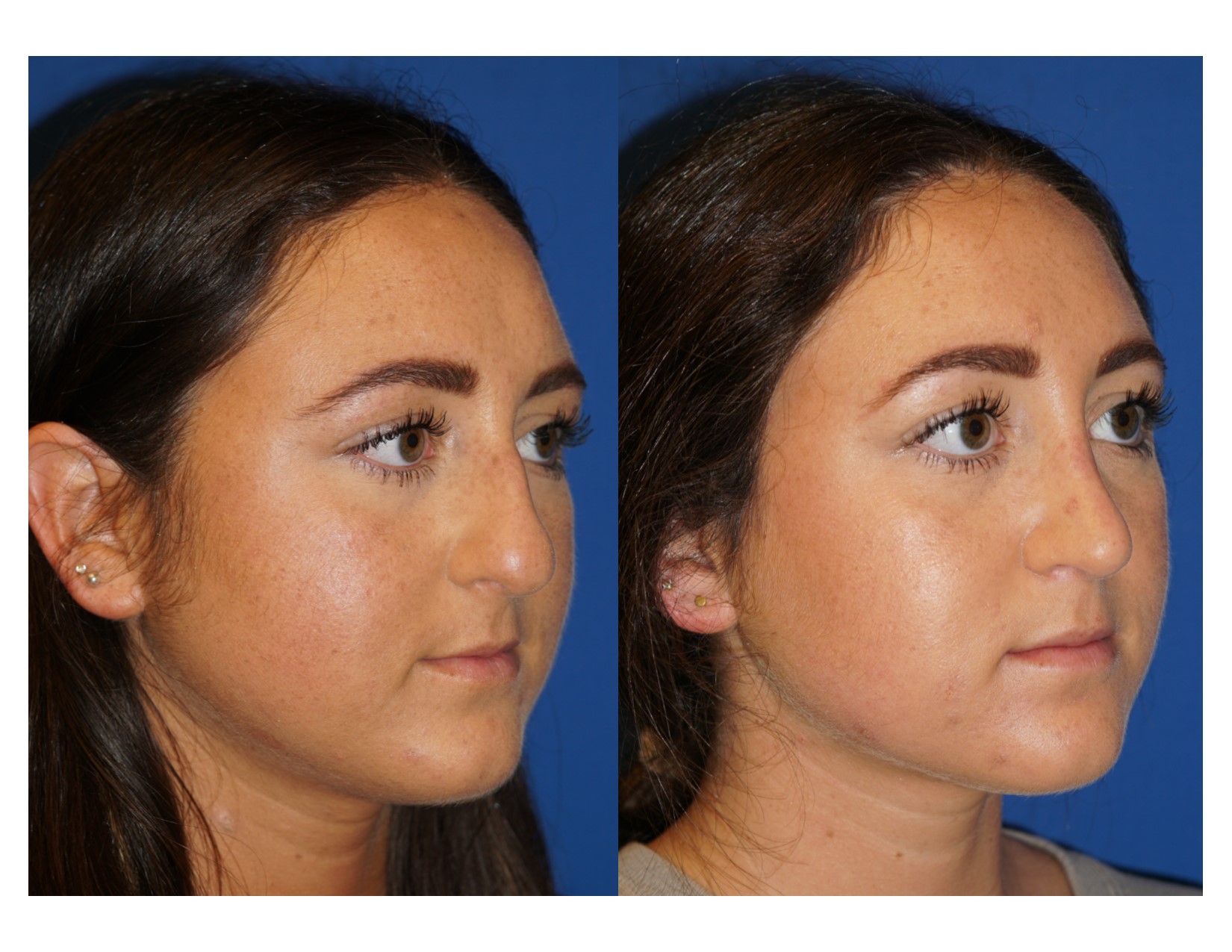 Rhinoplasty 5 Image 3