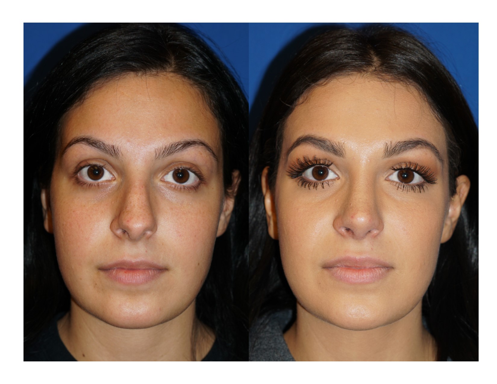 Rhinoplasty 6 Image 3