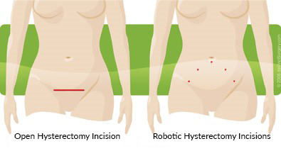 Robotic hysterectomy incisions