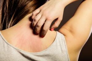 The Most Common Sun Irritations (And How To Treat Them)