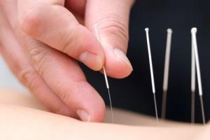 Closeup of five acupuncture needles in the skin