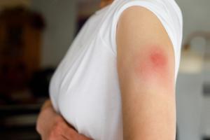 Girl with staph infection and redness on upper arm