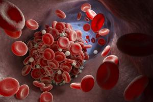 Depiction of red blood cells forming a blood clot