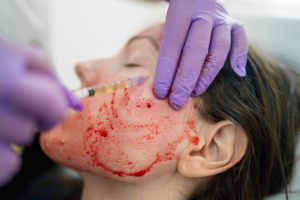 Platelet Rich Plasma (PRP) Vampire Facials