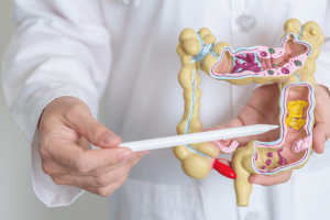 Summit Health gastroenterologist with colon model showing inflammatory bowel disease and colitis symptoms