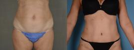 Abdominoplasty (tummy tuck) and liposuction
