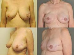 Bilateral expander breast reconstruction