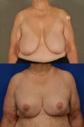 Expander breast reconstruction 